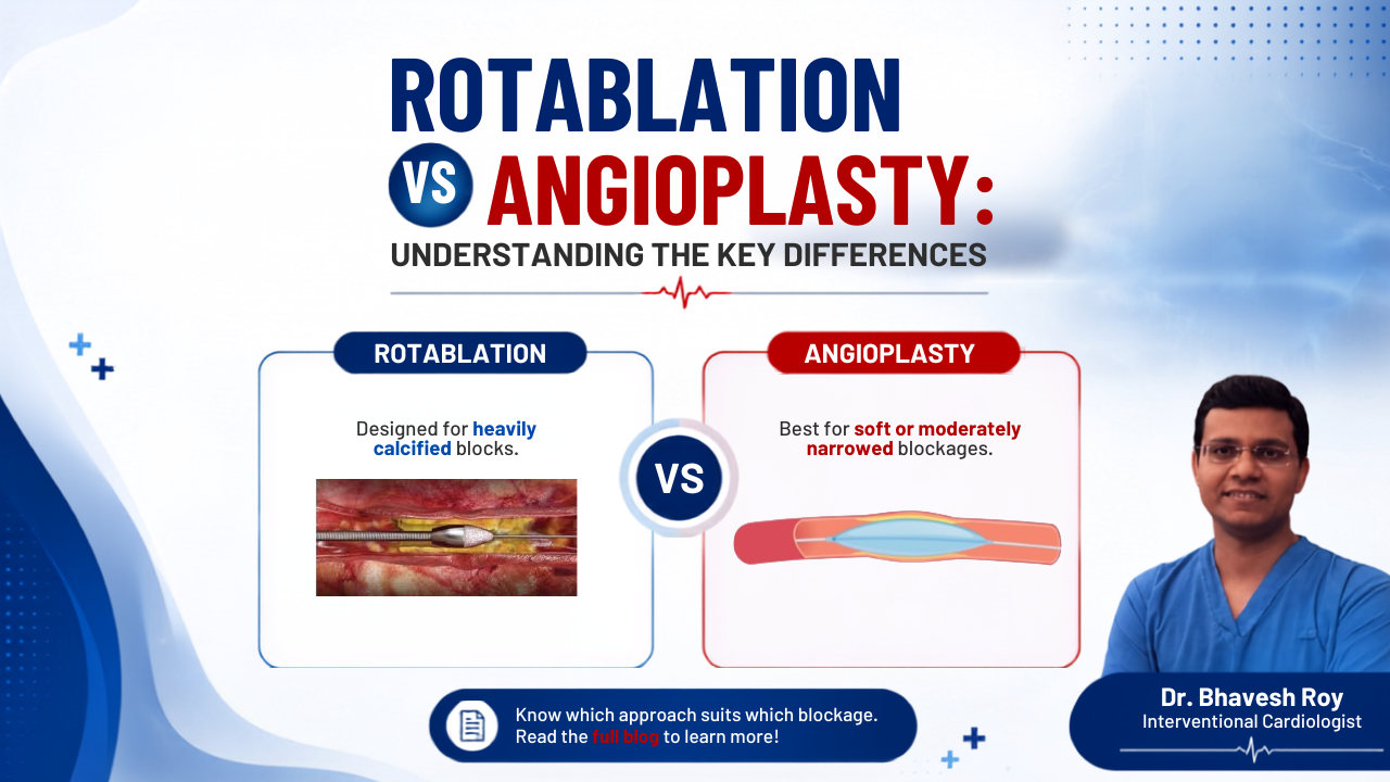 Infographic comparing Rotablation vs Angioplasty for coronary artery disease treatment, explaining that rotablation is used for heavily calcified coronary artery blockages while angioplasty is used for soft or moderately narrowed arteries. Features key differences, medical illustrations of both procedures, and Dr. Bhavesh Roy, Interventional Cardiologist.