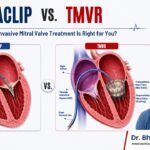 MitraClip vs TMVR comparison infographic by Dr. Bhavesh Roy showing minimally invasive treatment options for mitral valve disease and mitral regurgitation.