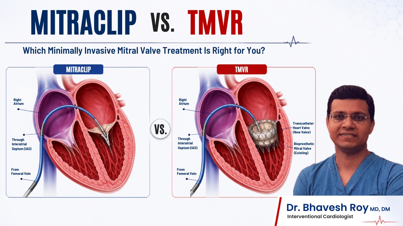 MitraClip vs TMVR comparison infographic by Dr. Bhavesh Roy showing minimally invasive treatment options for mitral valve disease and mitral regurgitation.